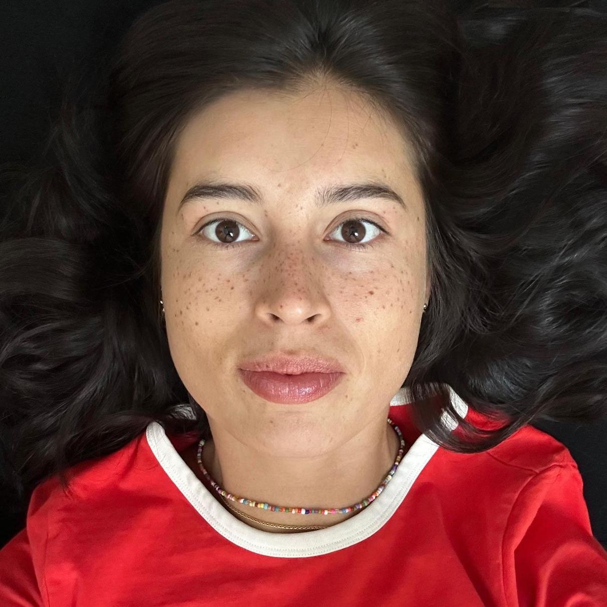 Après : la même cliente avec ses taches de rousseur pigmentées sur le nez et les pommettes, le lendemain de la séance